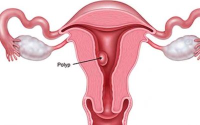 Polyp tử cung là gì và phương pháp điều trị bệnh hiệu quả!