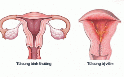 Viêm tử cung: Nguyên nhân, dấu hiệu, chẩn đoán và điều trị